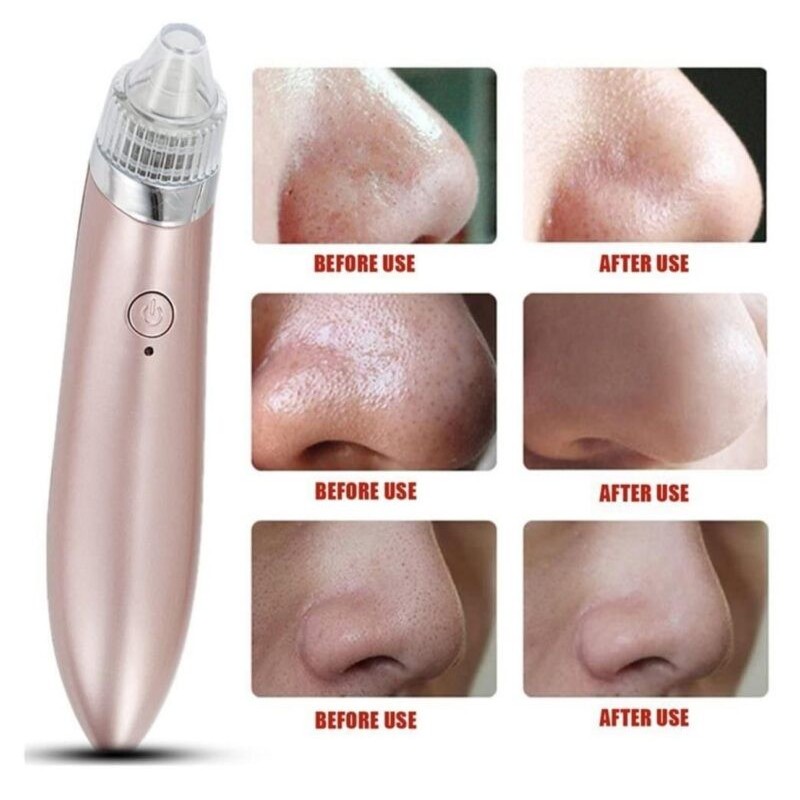 Aspiratore Punti Neri Professionale