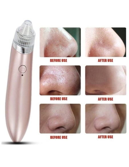 Aspiratore Punti Neri Professionale